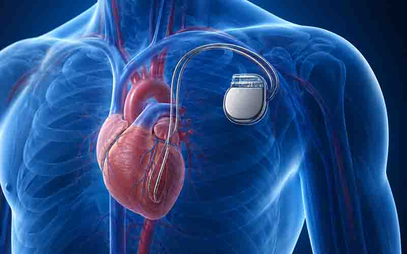 Angiography